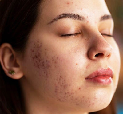 Stubborn Acne Treatment in Delhi